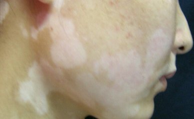 颈部白癜风有什么样的症状