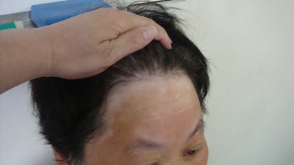 盐城白癜风医院