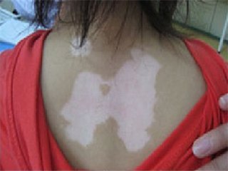 苏州白癜风疾病可以如何进行预防