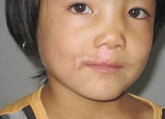 孩子得白癜风怎么办