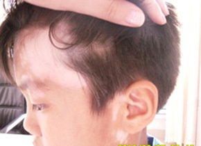 头部白癜风需要治疗多久