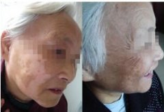中老年患上白癜风应该怎么医治