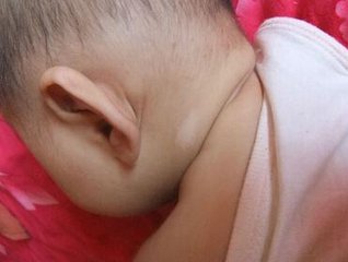 儿童颈部白癜风怎么办