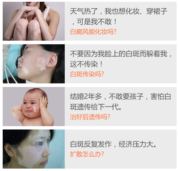 白癜风对女性的危害