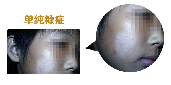 白癜风和白色糠疹的区别是什么?