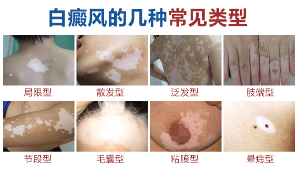 盐城白癜风医院