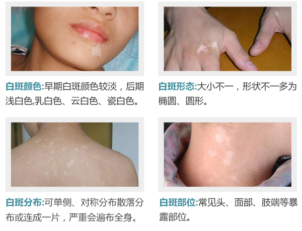 白癜风的症状表现是什么