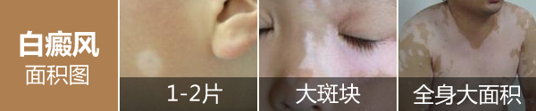 盐城白癜风医院