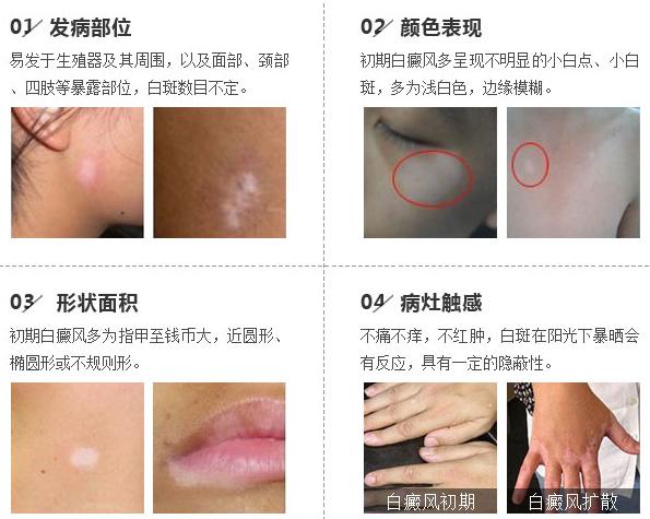白癜风症状有什么表现