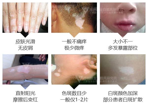 白癜风晚期症状表现有哪些