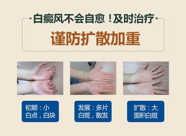 没有扩散的白癜风还用治吗