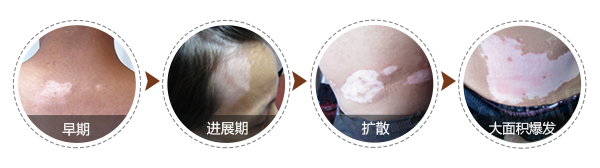 怎样判断白斑病的轻重呢