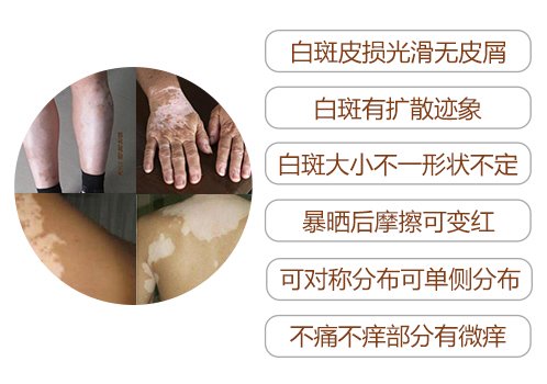 白癜风患病初期有哪些典型症状