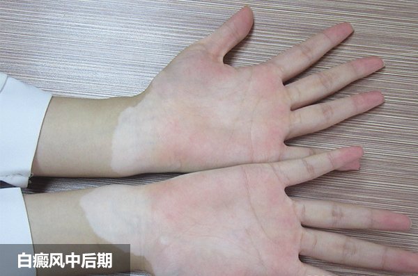 手部白癜风护理方法