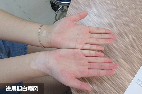 手指白斑是白斑病吗