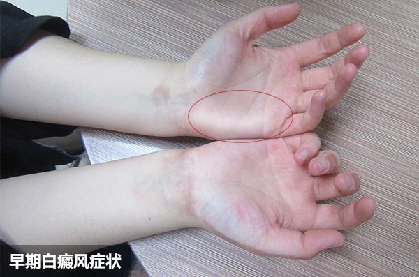盐城白癜风医院