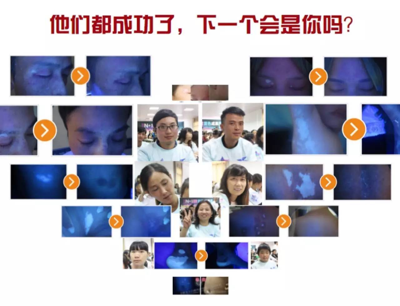 治好白癜风的关键是什么