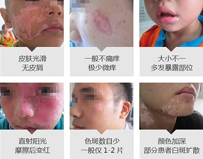 脸上出现小白点是白癜风吗