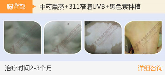 后背早期白癜风怎么治疗