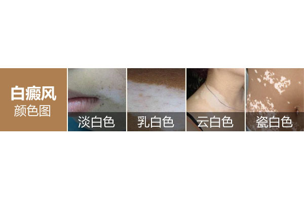 白癜风病发时有什么明显的症状吗
