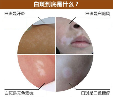 白癜风是怎样的一种皮肤病呢