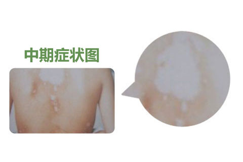 身上的白癜风到底是什么病