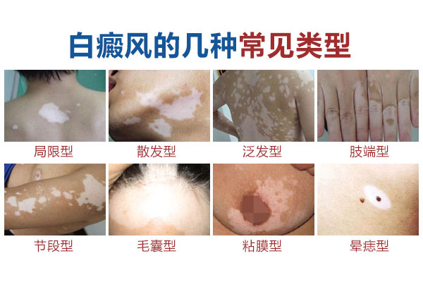 泛发型的白癜风有什么症状特点吗