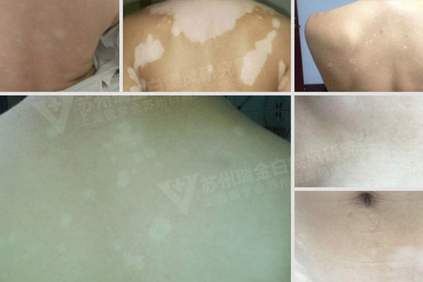晚期白癜风会有什么样的症状