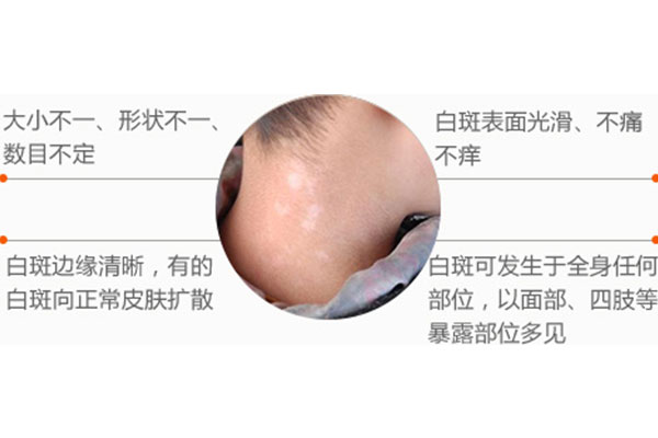 白癜风临床症状