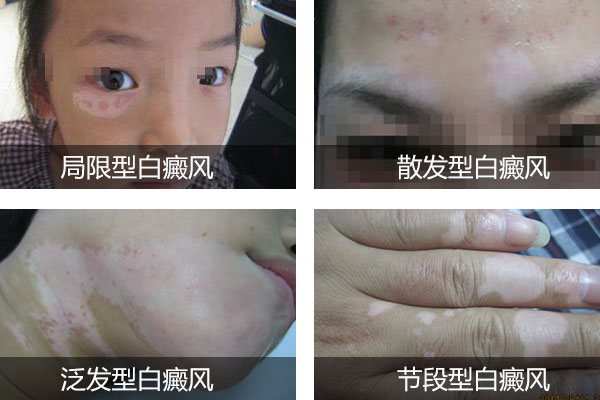 女性会患白癜风的原因都有哪些
