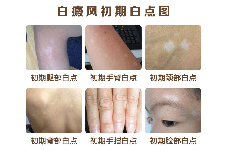 怎样去护理腿部的白癜风