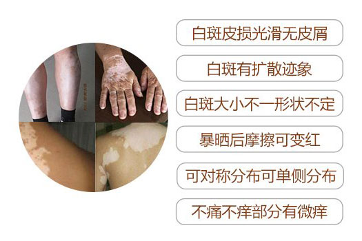 患上白癜风有什么症状特点吗