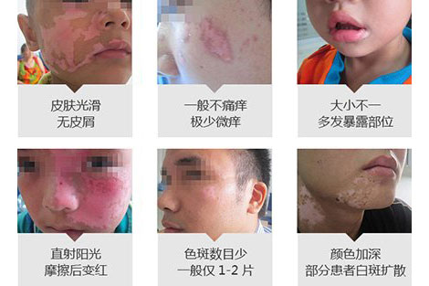 得了白癜风会有什么明显的变化吗