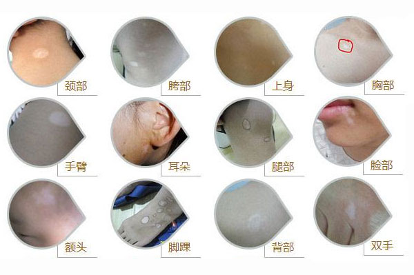 背部出现白癜风有什么症状表现吗
