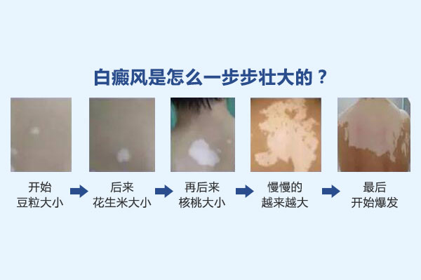 不同时期的白癜风究竟有什么不同