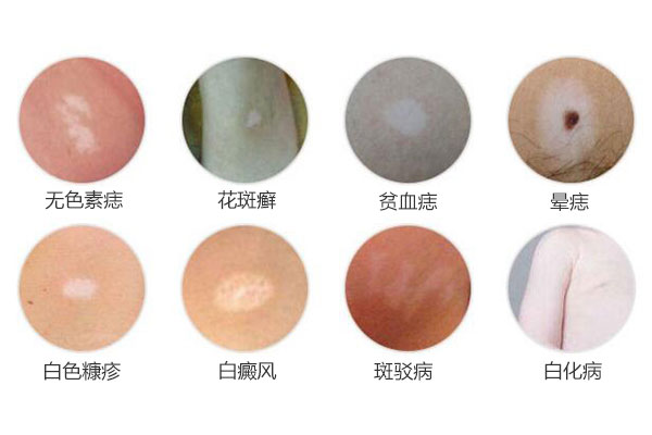 可能与白癜风混淆的疾病有哪些呢