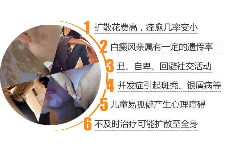患上白癜风可能还会导致什么并发
