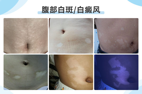 该怎么治疗长在肚子上的白癜风