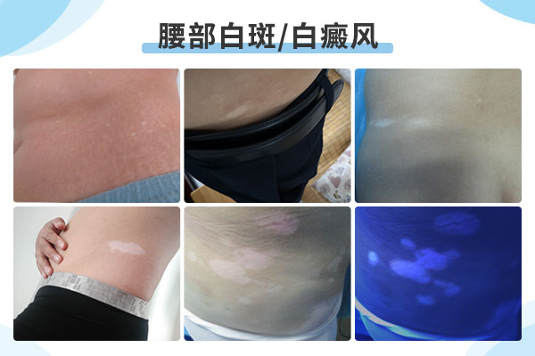 如何治疗腹部白癜风?