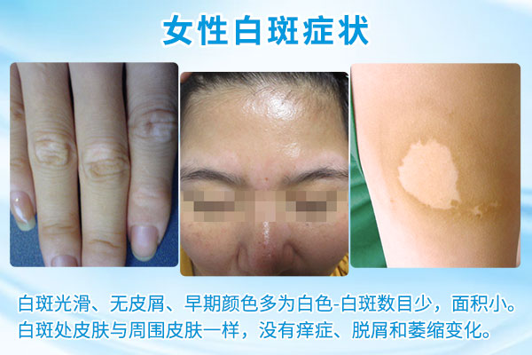 为什么女性手上的白癜风这么难治?