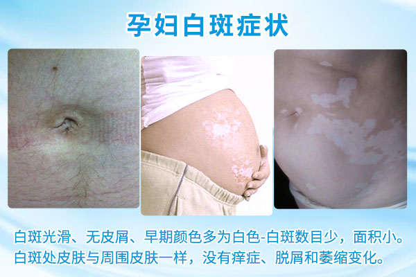 怀孕的妇女得了白癜风该怎么办?