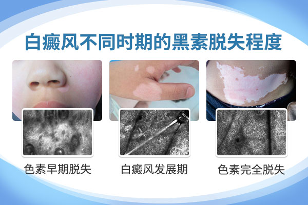 怎么去判断白癜风的严重程度呢?