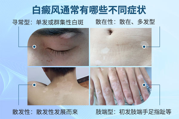 白癜风发作的症状有哪些?