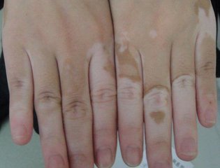 手上的皮肤变白是怎么回事?