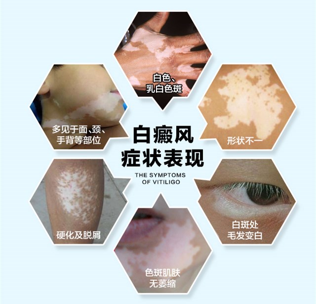 肢端型白癜风是什么样的