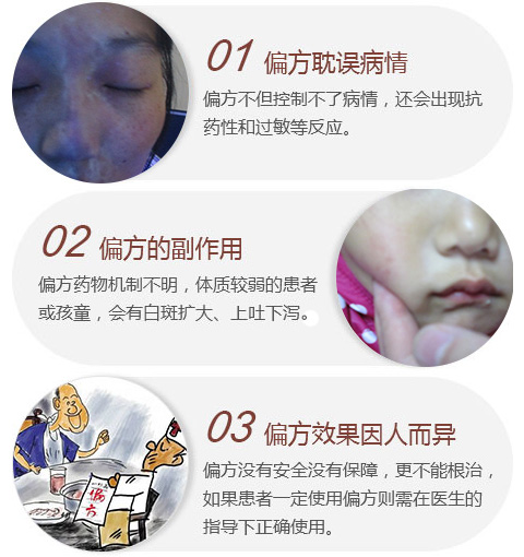偏方治疗白癜风很长时间都没效果咋回事？