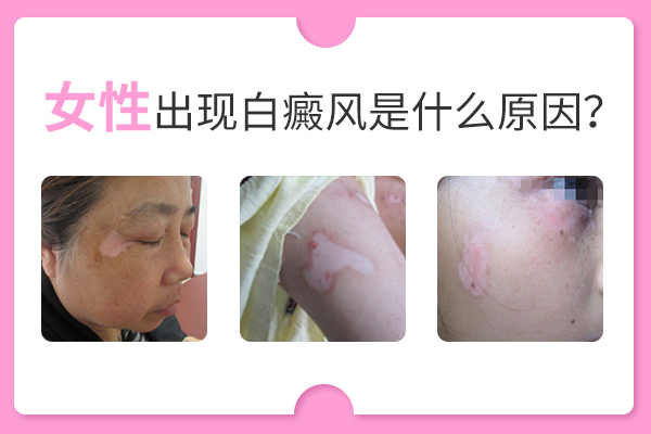 女性胸部患有白癜风的诱因是什么