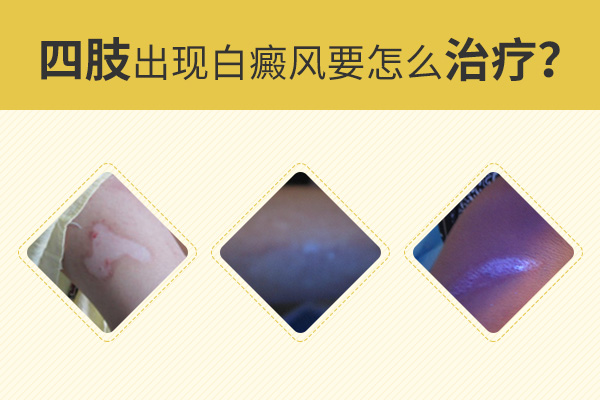 白癜风长在了手上要怎么治疗?