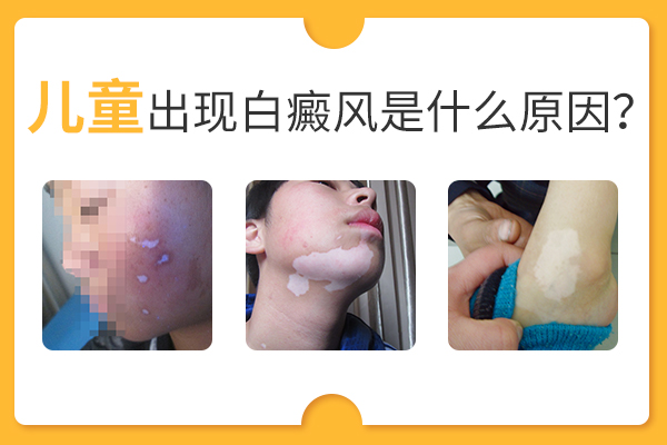是什么引发了儿童白癜风呢?