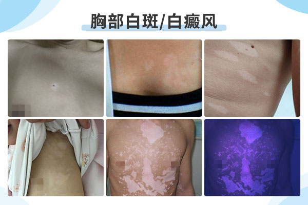 胸部白癜风的症状?